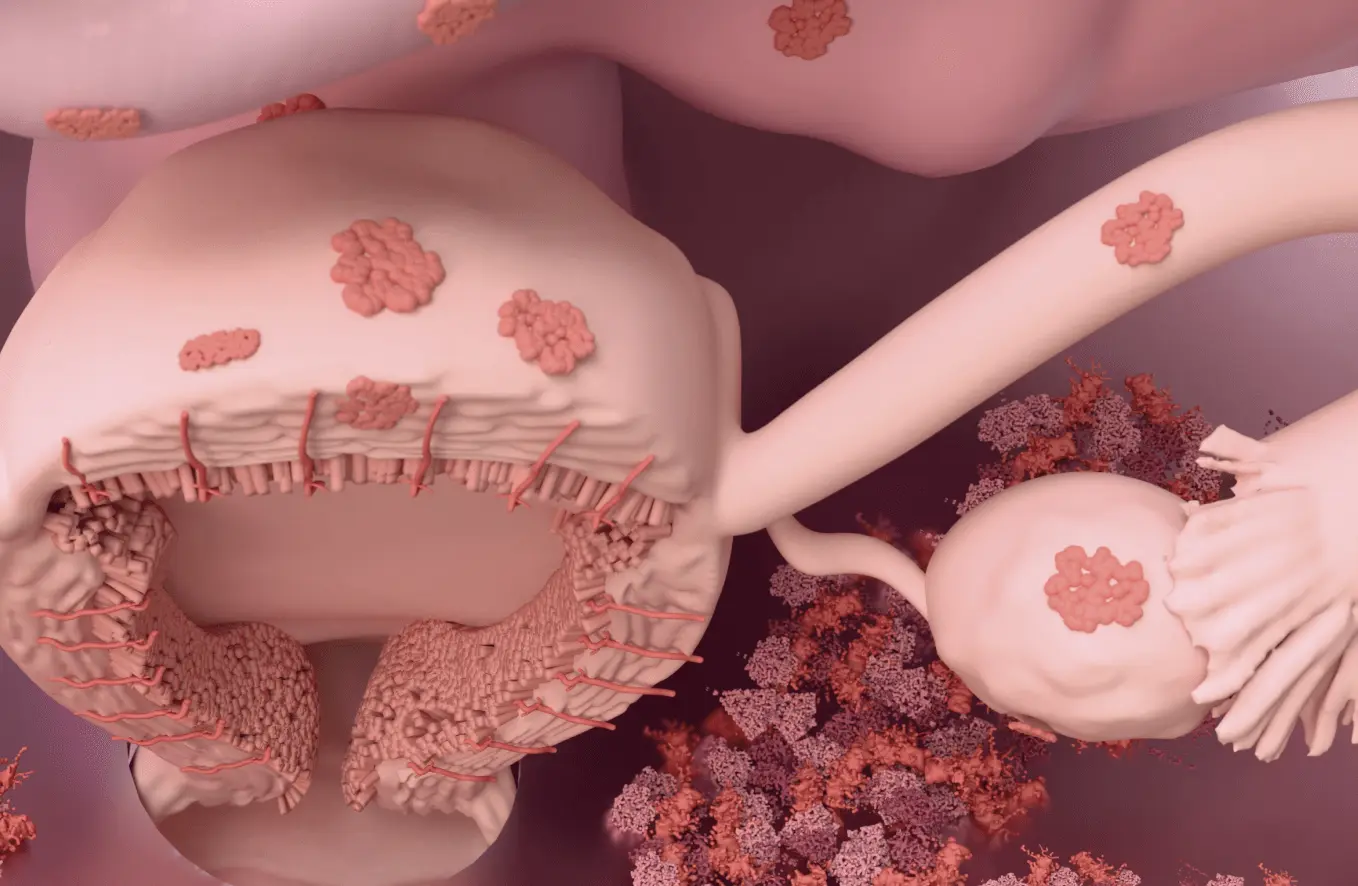 Uncommon Symptoms of Endometriosis: Hidden Clues