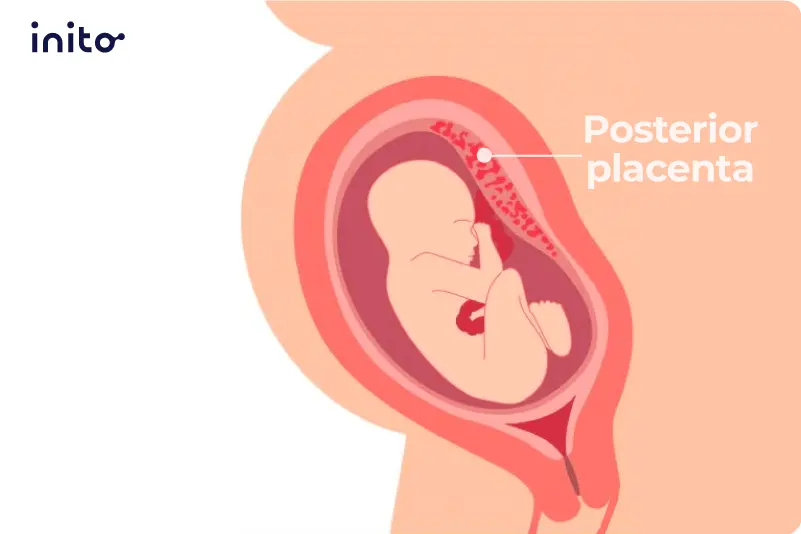 Posterior placenta